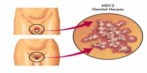 Herpes genitalis