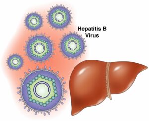 hepatitis