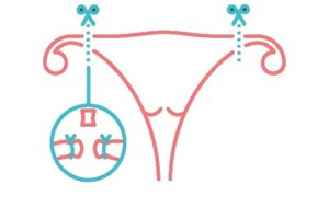 la esterilización de la mujer