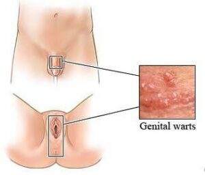 genital-warzen