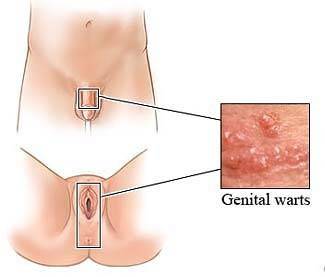 Genital-Warzen