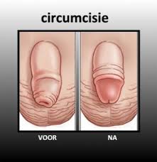 Circumcisie